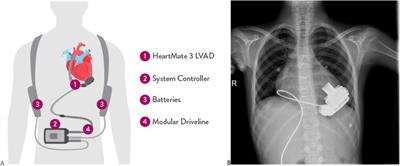 Outcomes of HeartMate 3 in pediatric patients with end-stage heart failure: a single-center preliminary experience from Turkey